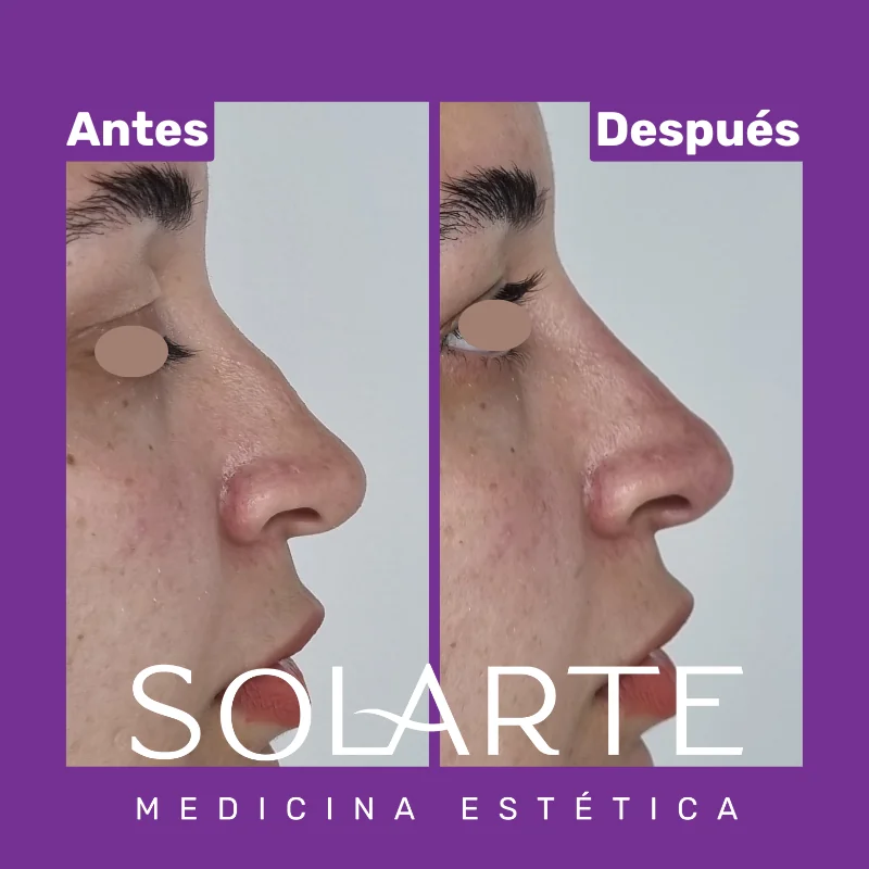 Antes y después de rinomodelación con RinoArte® — perfil femenino