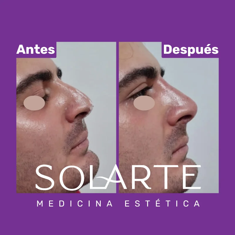 Antes y después de rinomodelación con RinoArte® — perfil masculino