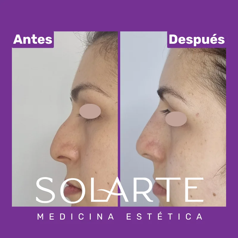 Antes y después de rinomodelación con RinoArte® — perfil femenino