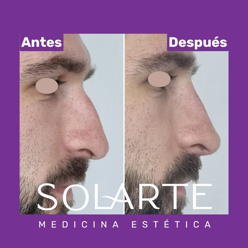 Antes y después de rinomodelación con RinoArte® — perfil masculino