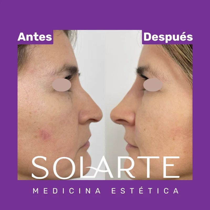Antes y después de rinomodelación con RinoArte® — perfil femenino