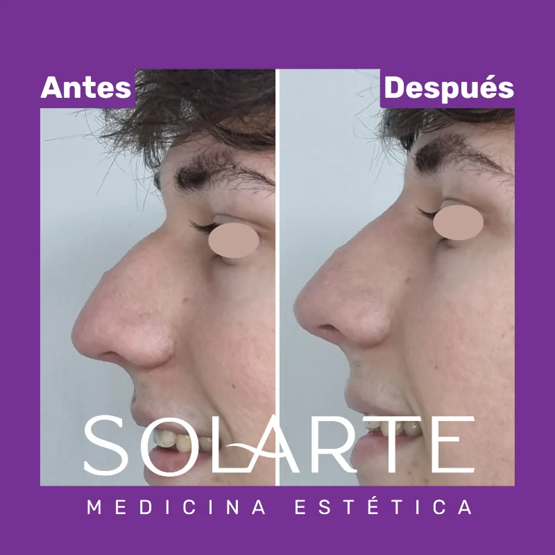 Antes y después de rinomodelación con RinoArte® — perfil masculino