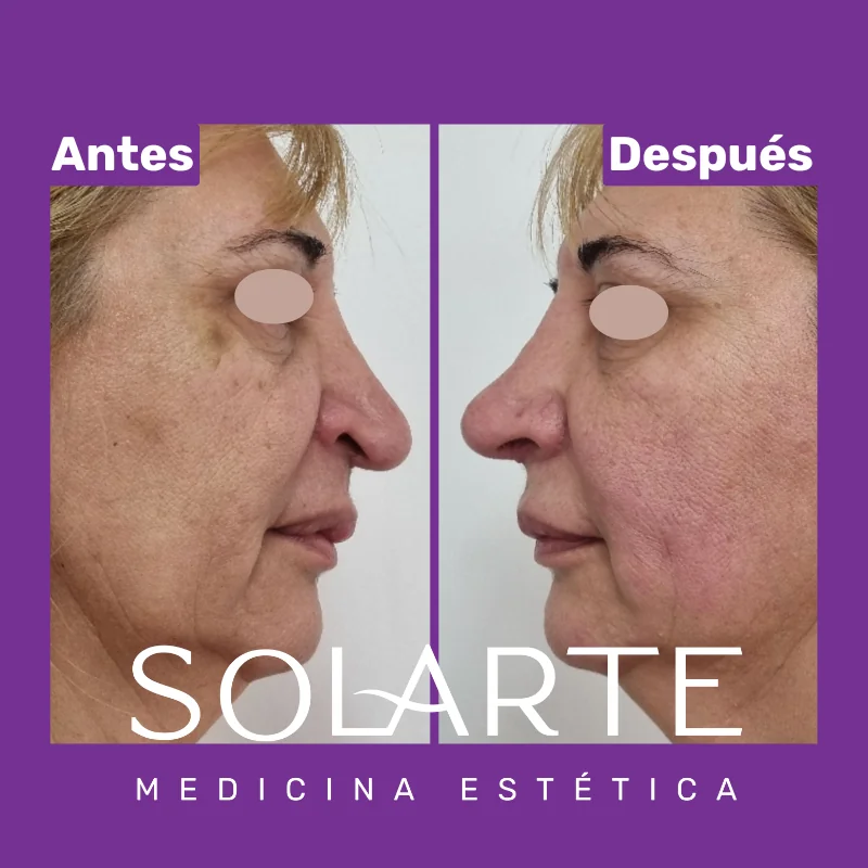 Antes y después de rinomodelación con RinoArte® — perfil femenino