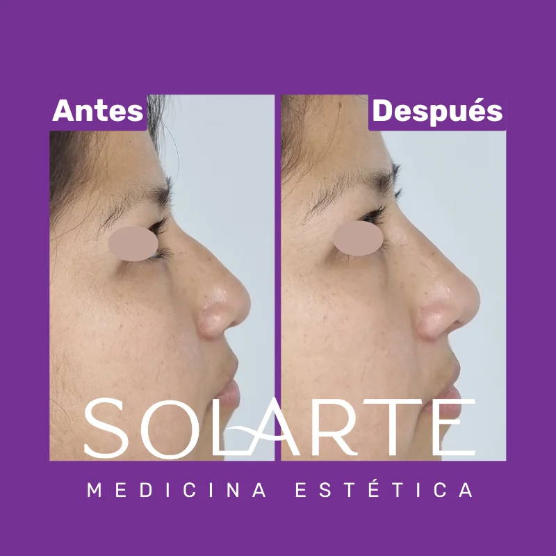 Antes y después de rinomodelación con RinoArte® — perfil masculino