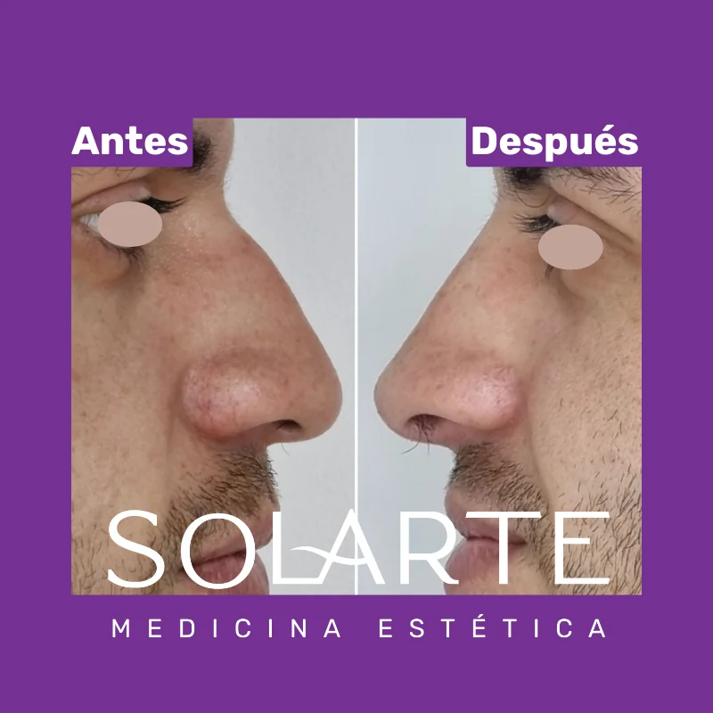 Antes y después de rinomodelación con RinoArte® — perfil masculino