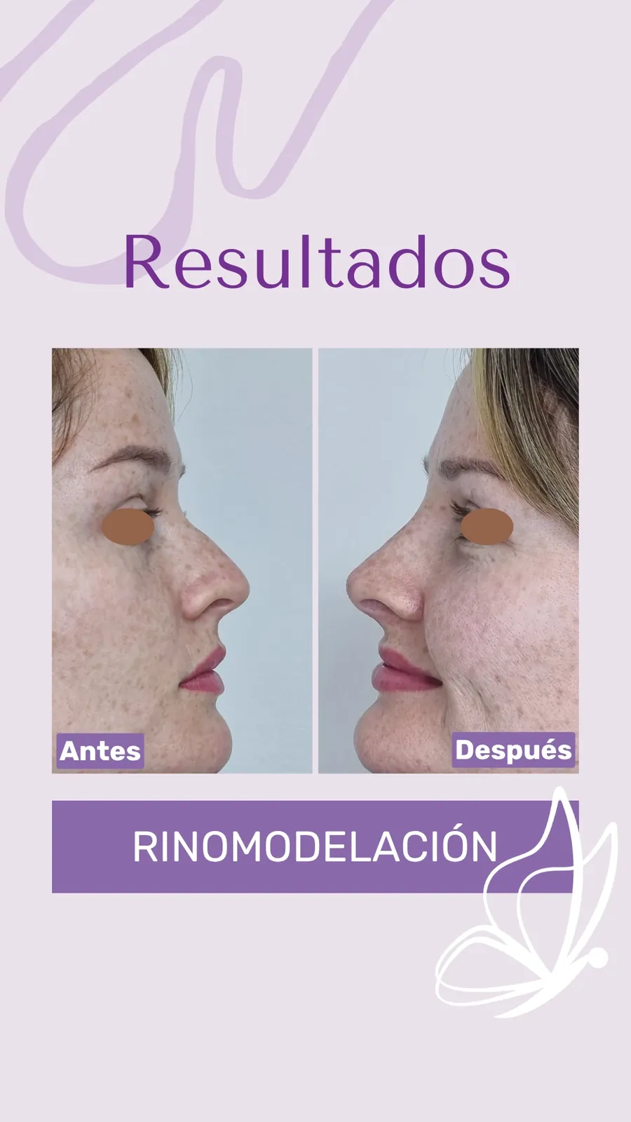 Antes y después de rinomodelación con RinoArte® — perfil femenino