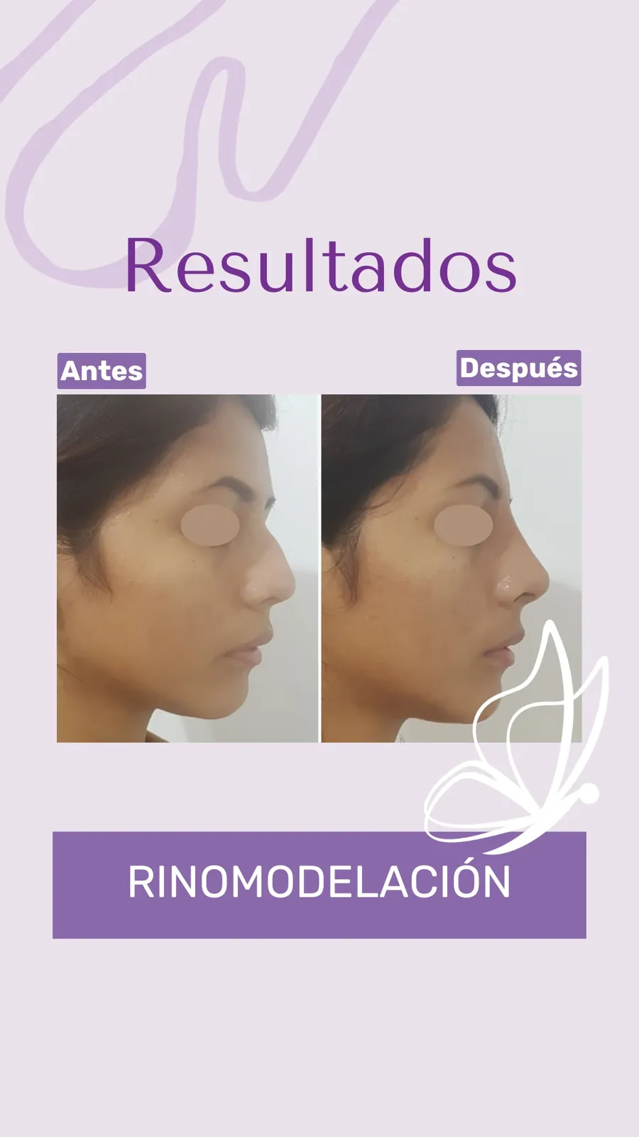 Antes y después de rinomodelación con RinoArte® — perfil femenino